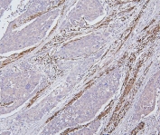 IHC staining of FFPE human esophagus squama cancer with Desmin antibody. HIER: boil tissue sections in pH6, 10mM citrate buffer, for 20 min and allow to cool before testing.