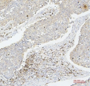 IHC staining of FFPE human lung cancer with CD43 antibody. HIER: boil tissue sections in pH6, 10mM citrate buffer, for 20 min and allow to cool before testing.