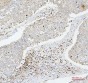 IHC staining of FFPE human lung cancer with CD43 antibody. HIER: boil tissue sections in pH6, 10mM citrate buffer, for 20 min and allow to cool before testing.
