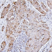 IHC staining of FFPE human breast cancer with PRKCD antibody. HIER: boil tissue sections in pH6, 10mM citrate buffer, for 20 min and allow to cool before testing.