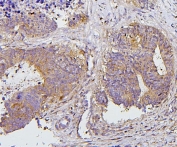IHC staining of FFPE human colon cancer with PRKCD antibody. HIER: boil tissue sections in pH6, 10mM citrate buffer, for 20 min and allow to cool before testing.