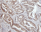 IHC staining of FFPE human colon with PTBP1 antibody. HIER: boil tissue sections in pH6, 10mM citrate buffer, for 20 min and allow to cool before testing.