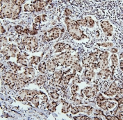 IHC staining of FFPE human breast cancer with PTBP1 antibody. HIER: boil tissue sections in pH6, 10mM citrate buffer, for 20 min and allow to cool before testing.