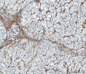 IHC staining of FFPE human adrenocortical adenoma tissue with Fibronectin antibody. HIER: boil tissue sections in pH8 EDTA for 20 min and allow to cool before testing.