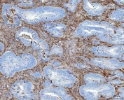 IHC staining of FFPE human colorectal adenocarcinoma tissue with Fibronectin antibody. HIER: boil tissue sections in pH8 EDTA for 20 min and allow to cool before testing.