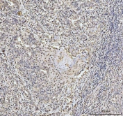 IHC staining of FFPE human squamous metaplasia of the renal pelvis with Nucleolin antibody. HIER: boil tissue sections in pH8 EDTA for 20 min and allow to cool before testing.