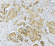 IHC staining of FFPE human breast cancer with Merlin antibody. HIER: boil tissue sections in pH6, 10mM citrate buffer, for 20 min and allow to cool before testing.