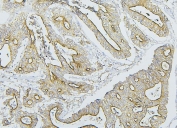 IHC staining of FFPE human intestinal cancer with Merlin antibody. HIER: boil tissue sections in pH6, 10mM citrate buffer, for 20 min and allow to cool before testing.