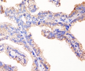 IHC staining of FFPE human kidney cancer with TJP1 antibody. HIER: boil tissue sections in pH6, 10mM citrate buffer, for 20 min and allow to cool before testing.