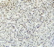 IHC staining of FFPE human liver cancer with PTBP2 antibody. HIER: boil tissue sections in pH6, 10mM citrate buffer, for 20 min and allow to cool before testing.