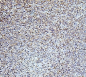 IHC staining of FFPE human melanoma with Fox2 antibody. HIER: boil tissue sections in pH6, 10mM citrate buffer, for 20 min and allow to cool before testing.