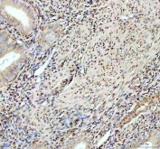 IHC staining of FFPE human melanoma with Fox2 antibody. HIER: boil tissue sections in pH6, 10mM citrate buffer, for 20 min and allow to cool before testing.