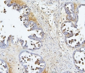 IHC staining of FFPE human ovarian cancer with TIE2 antibody. HIER: boil tissue sections in pH6, 10mM citrate buffer, for 20 min and allow to cool before testing.
