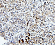 IHC staining of FFPE human pancreatic cancer with TRPV5 antibody. HIER: boil tissue sections in pH6, 10mM citrate buffer, for 20 min and allow to cool before testing.
