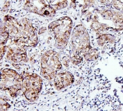 IHC staining of FFPE human breast cancer with Thioredoxin 2 antibody. HIER: boil tissue sections in pH6, 10mM citrate buffer, for 20 min and allow to cool before testing.