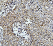IHC staining of FFPE human lung cancer with Thioredoxin 2 antibody. HIER: boil tissue sections in pH6, 10mM citrate buffer, for 20 min and allow to cool before testing.