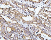 IHC staining of FFPE human intestinal cancer with Thioredoxin 2 antibody. HIER: boil tissue sections in pH6, 10mM citrate buffer, for 20 min and allow to cool before testing.