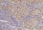 IHC staining of FFPE human breast cancer with B7H4 antibody. HIER: boil tissue sections in pH6, 10mM citrate buffer, for 20 min and allow to cool before testing.