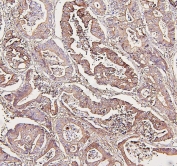 IHC staining of FFPE human intestinal cancer with Aldolase A antibody. HIER: boil tissue sections in pH6, 10mM citrate buffer, for 20 min and allow to cool before testing.