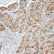 IHC staining of FFPE human breast cancer with Aldolase A antibody. HIER: boil tissue sections in pH6, 10mM citrate buffer, for 20 min and allow to cool before testing.