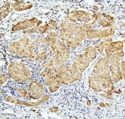 IHC staining of FFPE human breast cancer with BubR1 antibody. HIER: boil tissue sections in pH6, 10mM citrate buffer, for 20 min and allow to cool before testing.