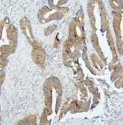 IHC staining of FFPE human colon cancer with BubR1 antibody. HIER: boil tissue sections in pH6, 10mM citrate buffer, for 20 min and allow to cool before testing.