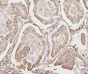 IHC staining of FFPE human intestinal cancer with Calreticulin antibody. HIER: boil tissue sections in pH6, 10mM citrate buffer, for 20 min and allow to cool before testing.
