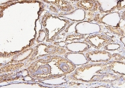 IHC staining of FFPE human thyroid cancer with Calreticulin antibody. HIER: boil tissue sections in pH6, 10mM citrate buffer, for 20 min and allow to cool before testing.