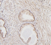 IHC staining of FFPE human prostate cancer with Calreticulin antibody. HIER: boil tissue sections in pH6, 10mM citrate buffer, for 20 min and allow to cool before testing.