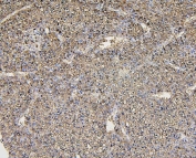 IHC staining of FFPE human liver cancer with Aldolase B antibody. HIER: boil tissue sections in pH6, 10mM citrate buffer, for 20 min and allow to cool before testing.