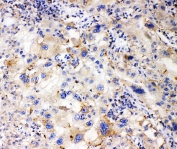 IHC staining of FFPE human liver cancer with APOL1 antibody. HIER: boil tissue sections in pH6, 10mM citrate buffer, for 20 min and allow to cool before testing.
