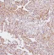 IHC staining of FFPE human liver cancer with CYP2E1 antibody. HIER: boil tissue sections in pH6, 10mM citrate buffer, for 20 min and allow to cool before testing.