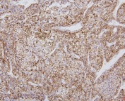 IHC staining of FFPE human liver cancer with CYP2E1 antibody. HIER: boil tissue sections in pH6, 10mM citrate buffer, for 20 min and allow to cool before testing.