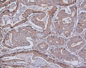 IHC staining of FFPE human rectal cancer with DDR1 antibody. HIER: boil tissue sections in pH6, 10mM citrate buffer, for 20 min and allow to cool before testing.