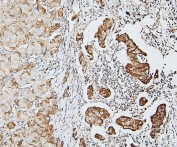 IHC staining of FFPE human breast cancer with DDR1 antibody. HIER: boil tissue sections in pH6, 10mM citrate buffer, for 20 min and allow to cool before testing.