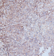 IHC staining of FFPE human lung cancer with DDR1 antibody. HIER: boil tissue sections in pH6, 10mM citrate buffer, for 20 min and allow to cool before testing.