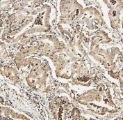IHC staining of FFPE human intestinal cancer with DDX5 antibody. HIER: boil tissue sections in pH6, 10mM citrate buffer, for 20 min and allow to cool before testing.