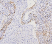 IHC staining of FFPE human lung cancer with Filamin A antibody. HIER: boil tissue sections in pH6, 10mM citrate buffer, for 20 min and allow to cool before testing.