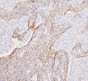 IHC staining of FFPE human lung cancer with Filamin A antibody. HIER: boil tissue sections in pH6, 10mM citrate buffer, for 20 min and allow to cool before testing.
