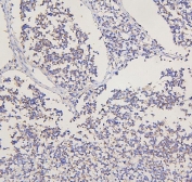 IHC staining of FFPE human glioma tissue with GRM2 antibody. HIER: boil tissue sections in pH8 EDTA for 20 min and allow to cool before testing.