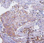 IHC staining of FFPE human breast cancer with CETP antibody. HIER: boil tissue sections in pH6, 10mM citrate buffer, for 20 min and allow to cool before testing.