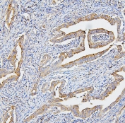 IHC staining of FFPE human intestinal cancer with CETP antibody. HIER: boil tissue sections in pH6, 10mM citrate buffer, for 20 min and allow to cool before testing.