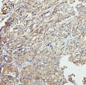 IHC staining of FFPE human stomach cancer with CETP antibody. HIER: boil tissue sections in pH6, 10mM citrate buffer, for 20 min and allow to cool before testing.