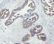 IHC staining of FFPE human ovarian cancer with CETP antibody. HIER: boil tissue sections in pH6, 10mM citrate buffer, for 20 min and allow to cool before testing.