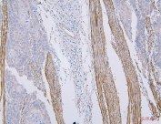 IHC staining of FFPE human esophagus squama cancer tissue with CD35 antibody. HIER: boil tissue sections in pH8 EDTA for 20 min and allow to cool before testing.