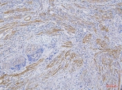 IHC staining of FFPE human endometrial carcinoma tissue with CD35 antibody. HIER: boil tissue sections in pH8 EDTA for 20 min and allow to cool before testing.