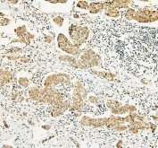 IHC staining of FFPE human breast cancer with ATRX antibody (nuclear and cytoplasmic staining seen here). HIER: boil tissue sections in pH6, 10mM citrate buffer, for 20 min and allow to cool before testing.