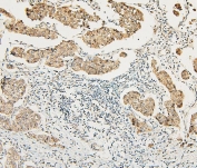 IHC staining of FFPE human breast cancer with ATRX antibody (nuclear and cytoplasmic staining seen here). HIER: boil tissue sections in pH6, 10mM citrate buffer, for 20 min and allow to cool before testing.