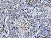 IHC staining of FFPE human laryngeal squamous cell carcinoma with HLA-DRA antibody. HIER: boil tissue sections in pH6, 10mM citrate buffer, for 20 min and allow to cool before testing.