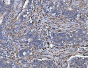 IHC staining of FFPE human duodenal adenocarcinoma with HLA-DRA antibody. HIER: boil tissue sections in pH6, 10mM citrate buffer, for 20 min and allow to cool before testing.